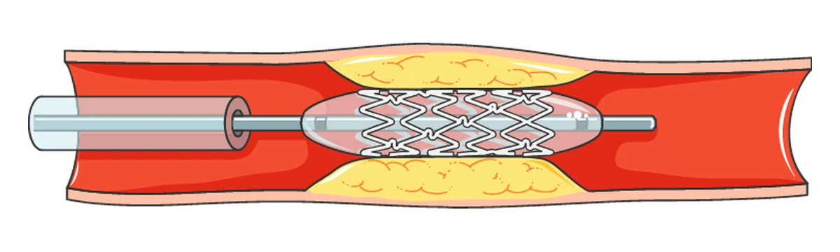A folded stent on a balloon catheter, positioned inside the narrowed section of the artery.