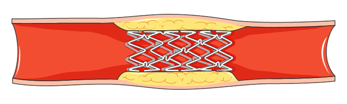 The opened stent left in place, holding the narrowed section of the artery open.